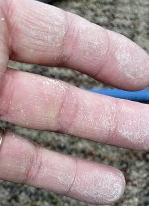 Dried Shampoo Residue On Fingers